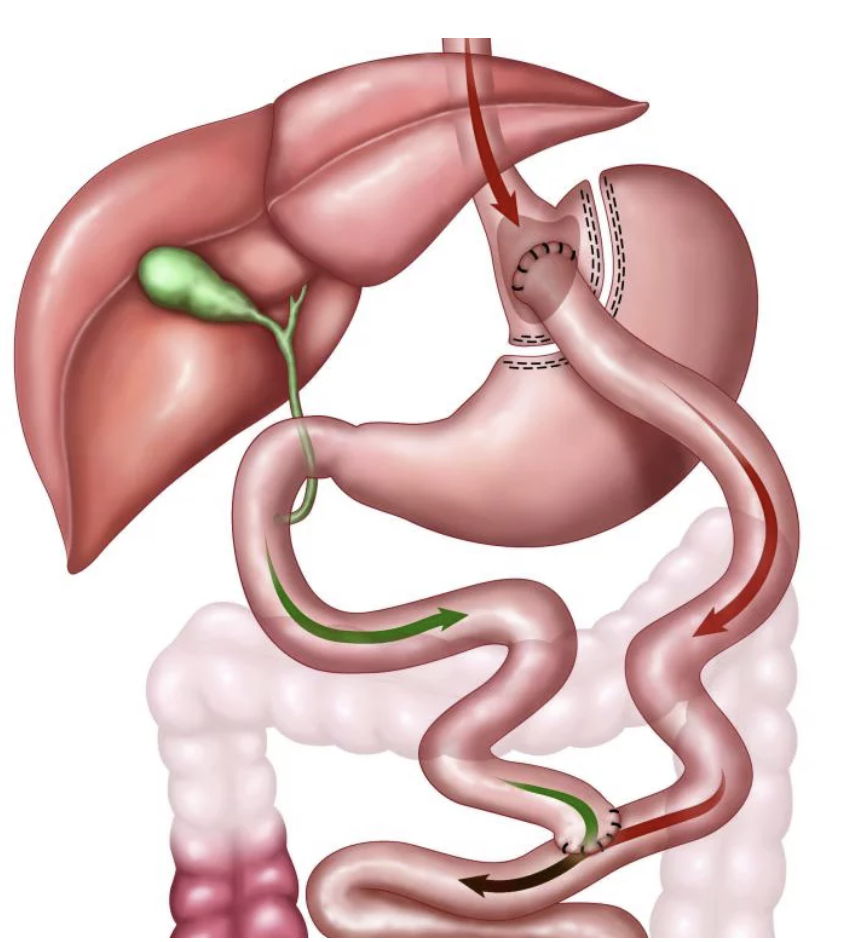 Gastric Bypass Reset Bariatrics